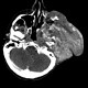 Hemangioma of face, extensive: CT - Computed tomography